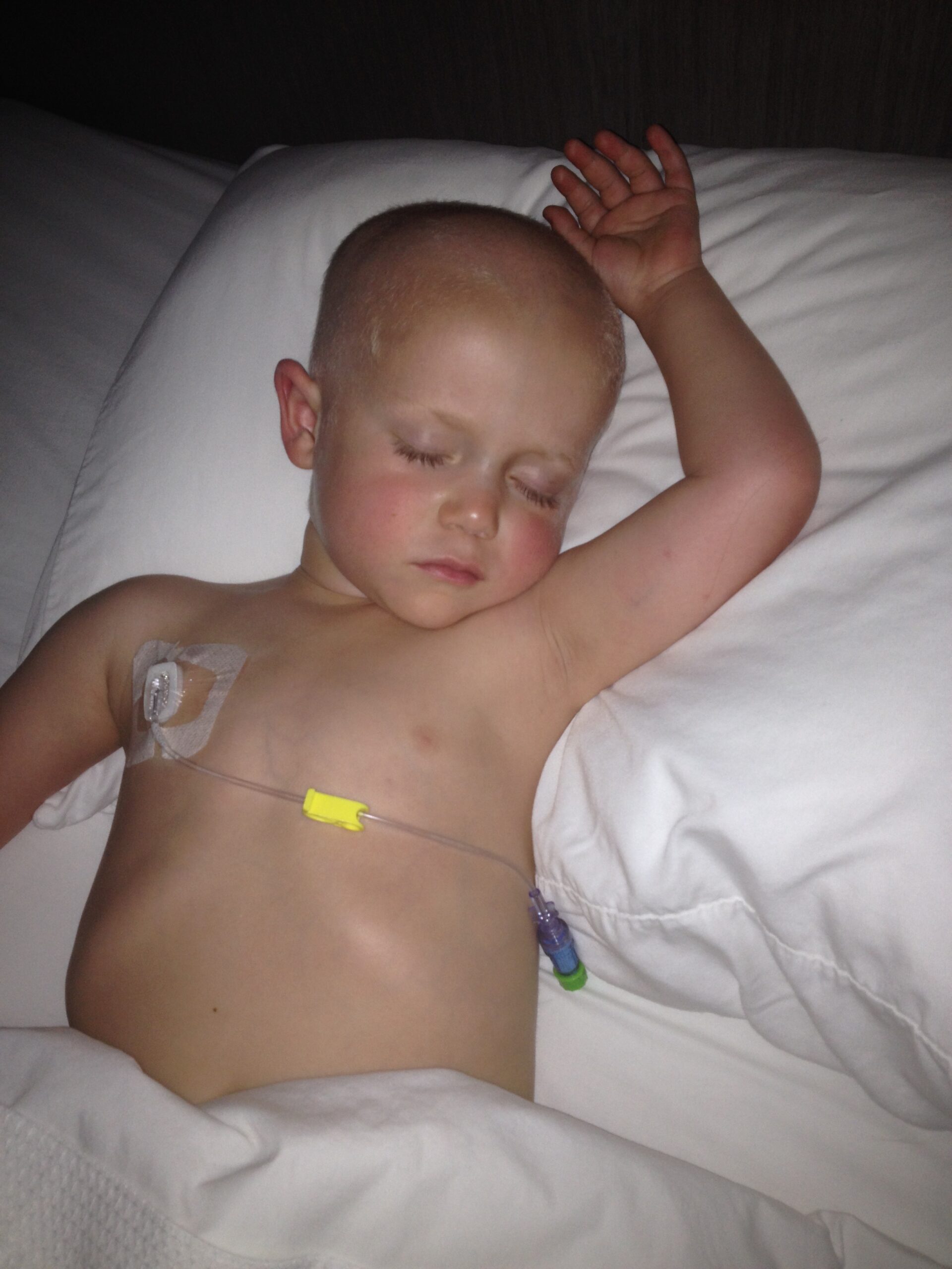 small child with cancer sleeping with port